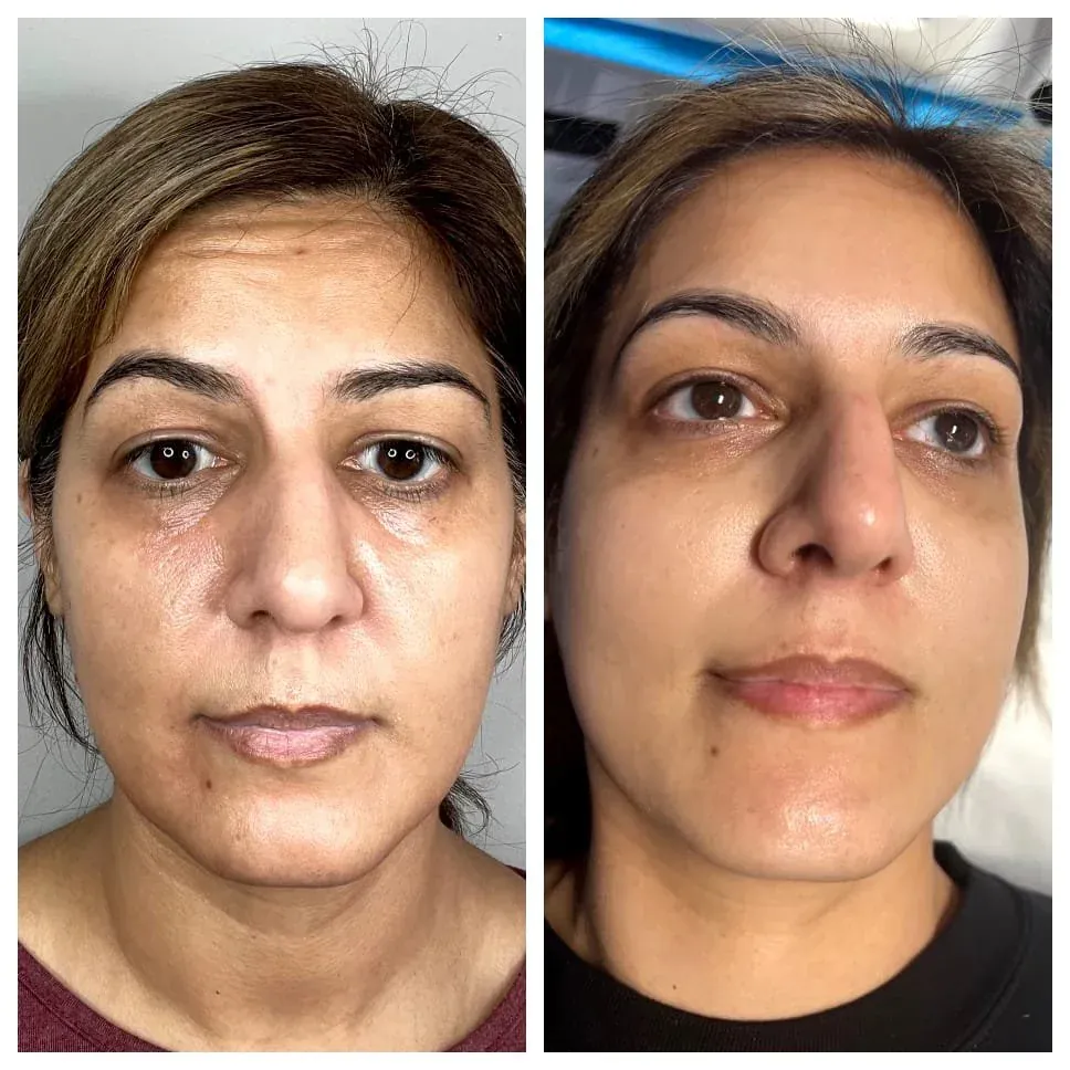 PRP and microneedling - Millennium Skin and Laser Clifton NJ PRP microneedling results at Northern New Jersey med spa
