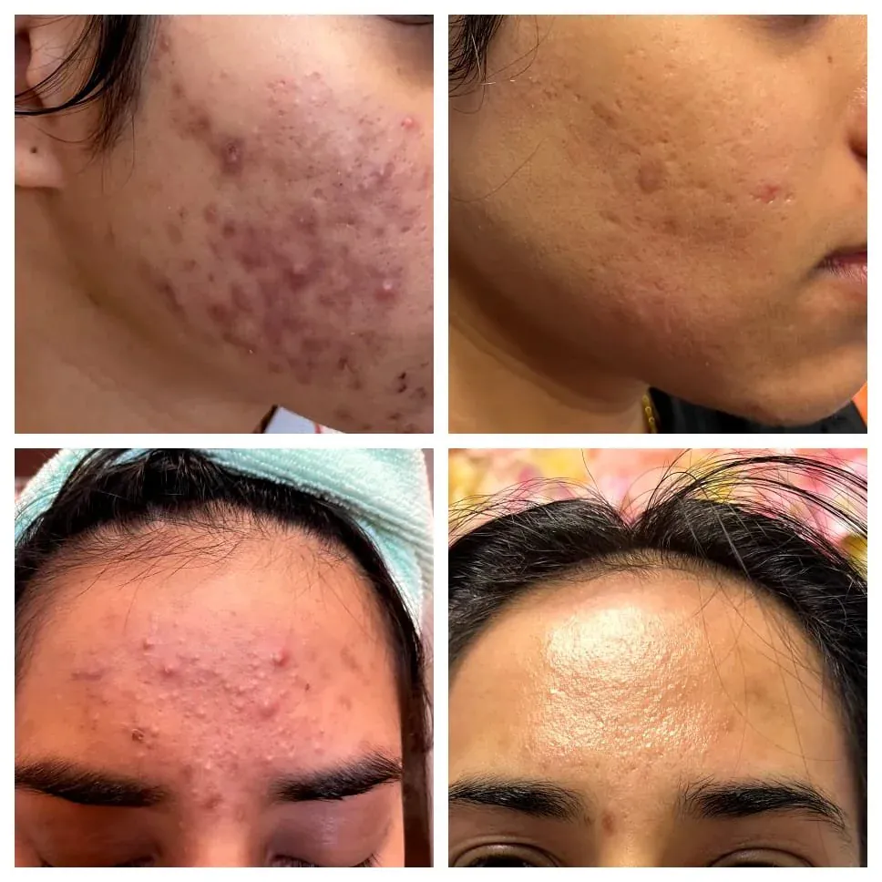 Acne laser treatment - Millennium Skin and Laser Clifton NJ Acne laser treatment before and after in Clifton NJ