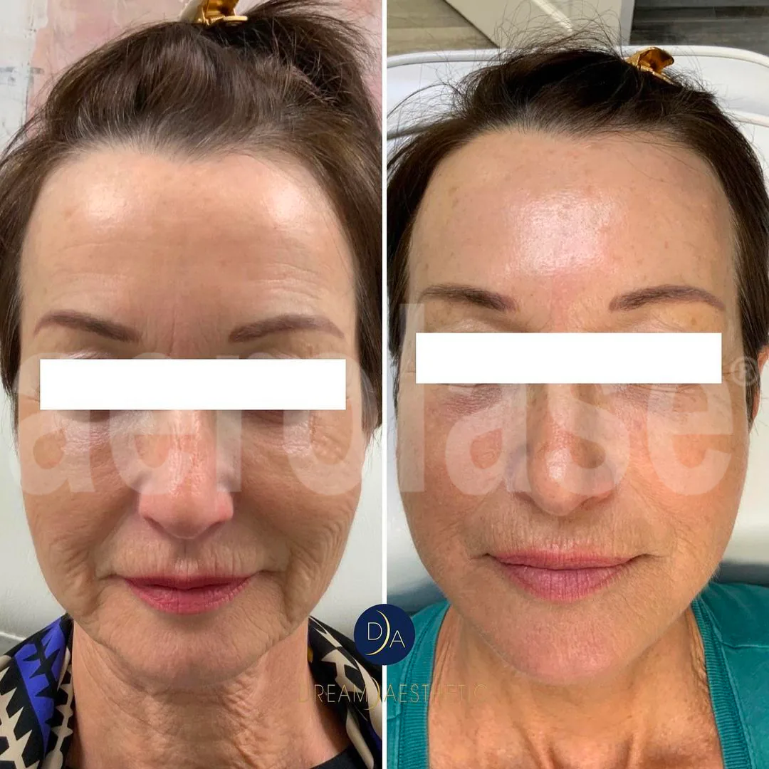 Skin rejuvenation - Millennium Skin and Laser Clifton NJ Anti-aging laser treatment before and after