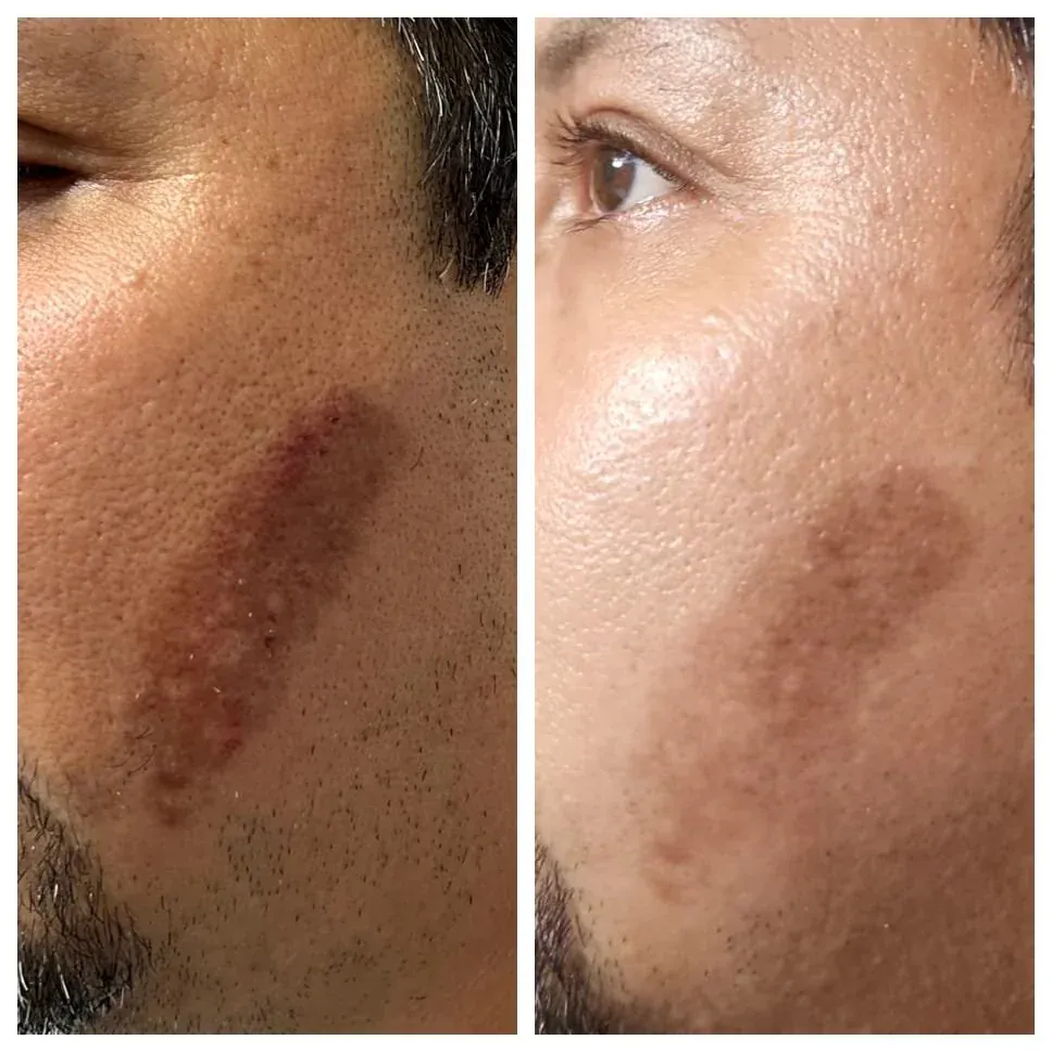 Pigment and discoloration - Millennium Skin and Laser Clifton NJ Laser pigmentation treatment results Clifton NJ